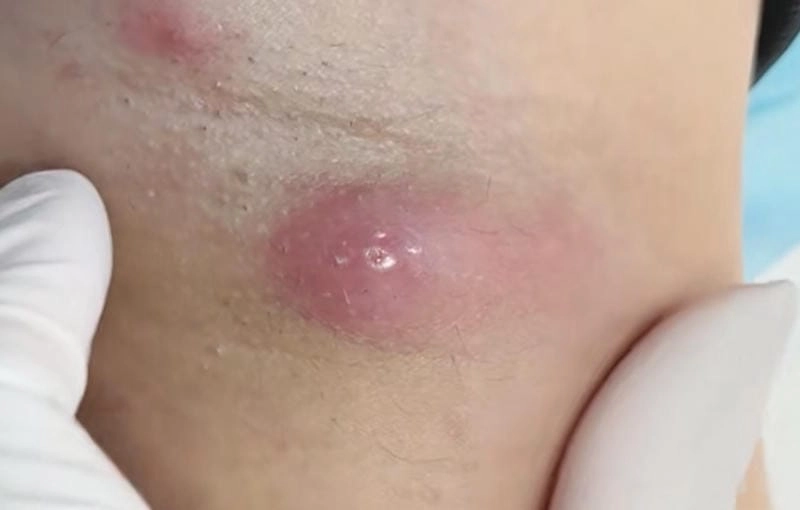 Dấu hiệu nhận biết khi bị lên ổ gà ở nách cần chữa