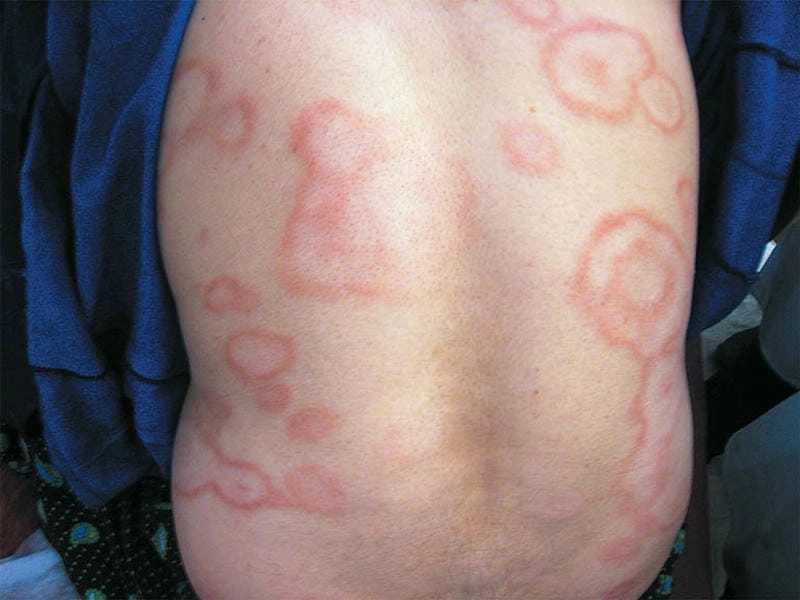 Hiểu đúng về bệnh máu phong ngứa nguy hiểm