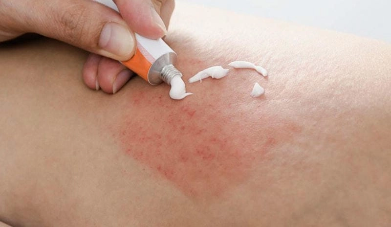 Tổng hợp rõ nét hình ảnh bị phong ngứa