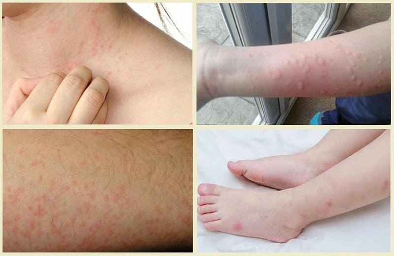 Giải đáp thắc mắc bệnh phong ngứa có lây không