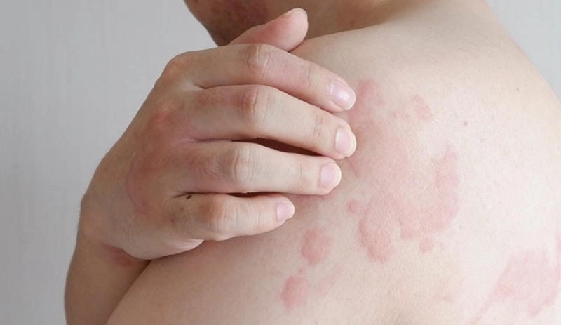 Xem ngay hình ảnh người bị bệnh phong chân thực