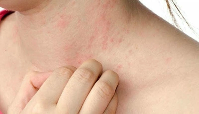 Nhận biết sớm tình trạng phong ngứa trên da
