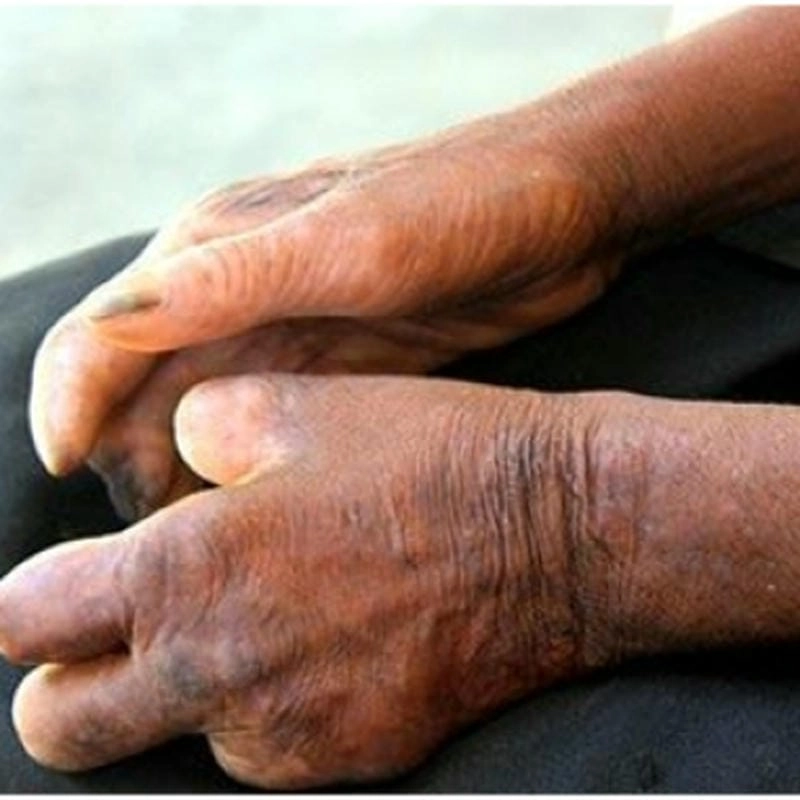 Phân tích chi tiết ảnh bệnh phong cùi