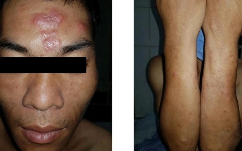 Bệnh phong cùi gây tổn thương nghiêm trọng