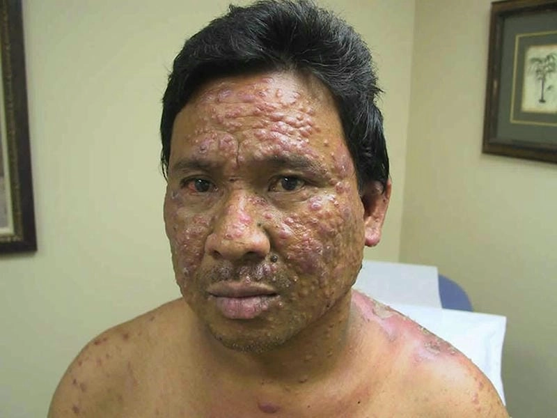 Xem ngay hình ảnh bệnh phong cùi chân thực