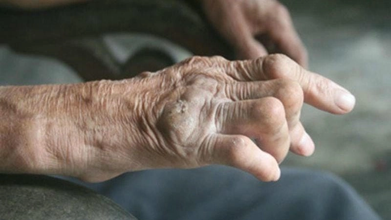 Tổng hợp triệu chứng phong cùi thường gặp