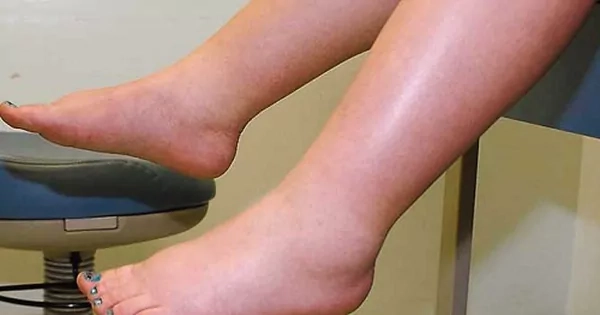 Bộ sưu tập hình ảnh phù chân voi hiếm gặp trong thực tế điều trị