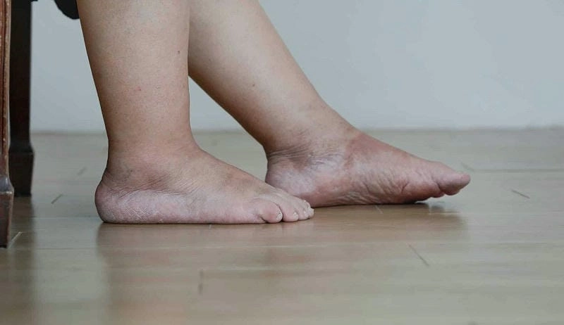 Triệu chứng điển hình của phù chân voi giun chỉ dễ nhận biết