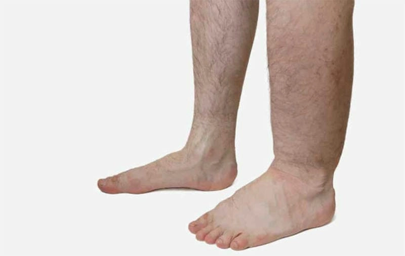 Cập nhật hình ảnh bị phù chân voi mới nhất hiện nay