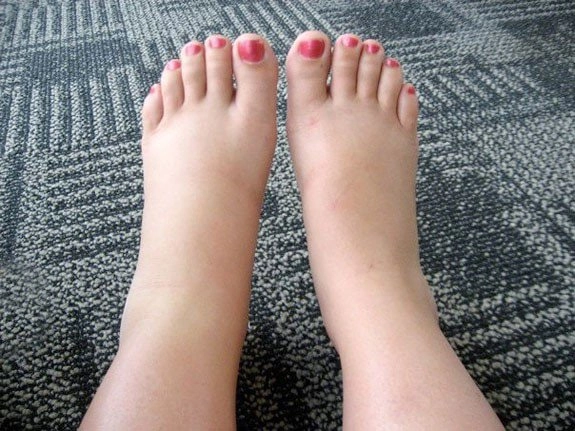 Bộ ảnh người phù chân voi phản ánh tình trạng bệnh nặng