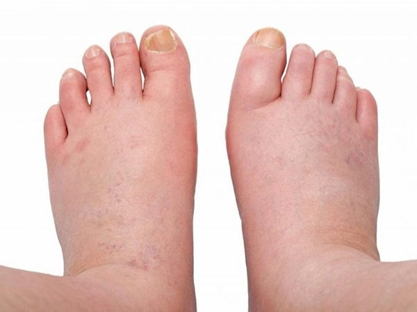 Xem ngay ảnh bệnh phù chân voi ở chân với biến chứng nặng