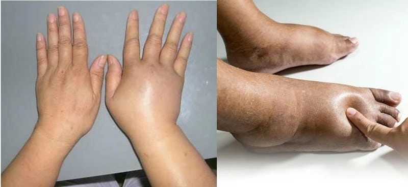 Hiểu rõ nguyên nhân và cách nhận biết phu chan voi