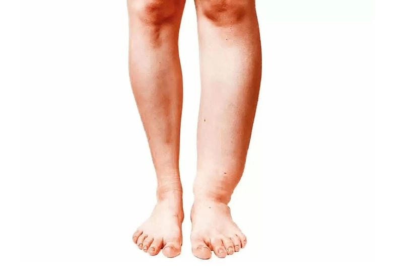 Hình ảnh minh họa chân thực của phù chân voi