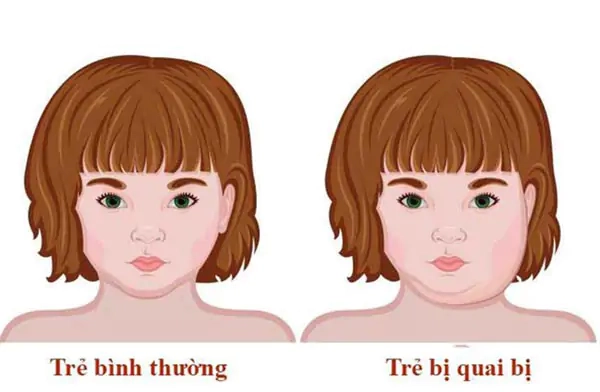 Triệu chứng đặc trưng trong hình ảnh quai bị sưng má