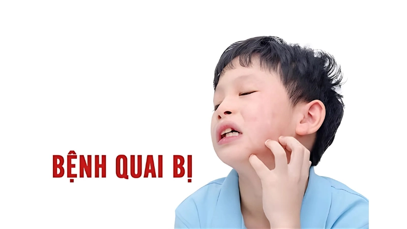 Hình ảnh bệnh quai bị là như thế nào