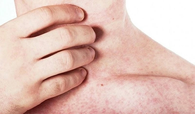 Bệnh rubella xuất hiện sau sốt nhẹ