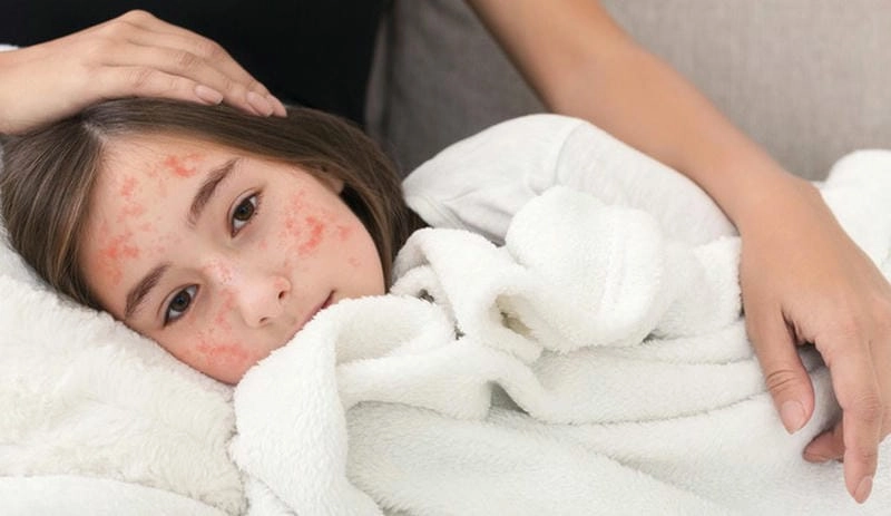 Dấu hiệu bệnh rubella thường là sốt nhẹ