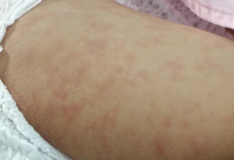 Ảnh bệnh rubella ở trẻ với biểu hiện phát ban