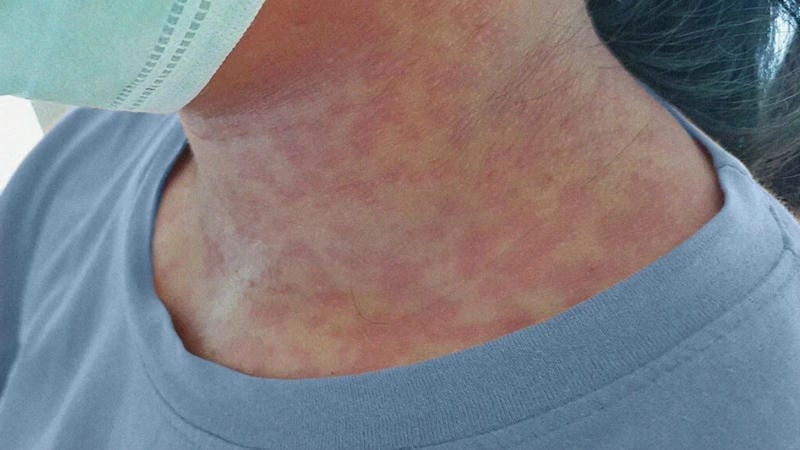 Ảnh bệnh rubella ở trẻ em khi phát ban đỏ