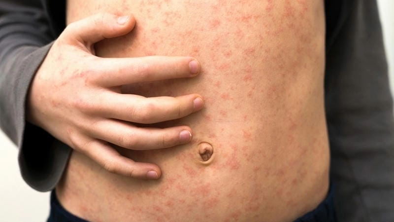 Triệu chứng sốt rubella ở trẻ em kéo dài vài ngày