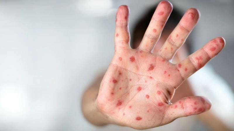 Hình ảnh triệu chứng bệnh rubella ở trẻ em dễ phát hiện