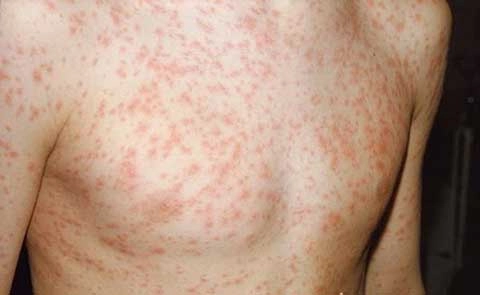  Bệnh rubella ở người lớn thường khó phát hiện