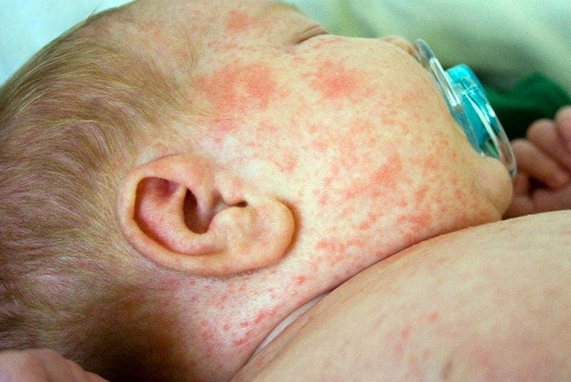 Bệnh rubella ở trẻ em gây phát ban