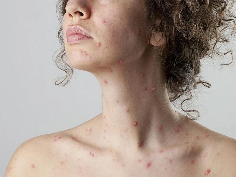 Bệnh rubella ở người lớn có nguy cơ biến chứng