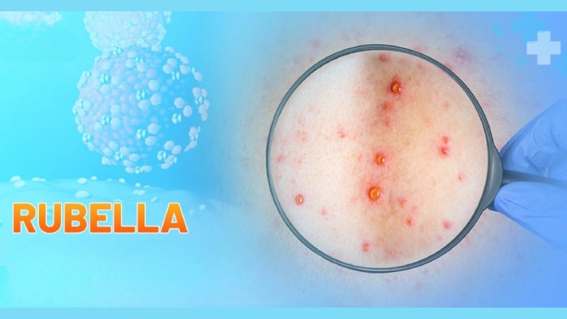 Hình ảnh bệnh rubella là như thế nào