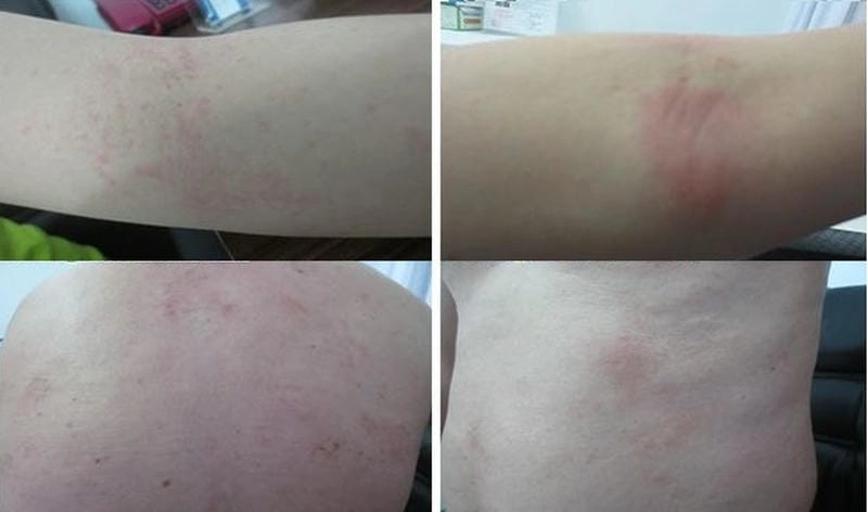 Hình ảnh người bị nhiễm sán chó thể hiện tình trạng dị ứng da