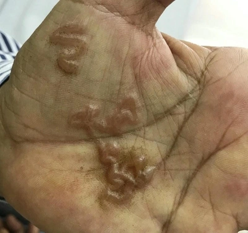 Dấu hiệu của bệnh sán chó ở người thường là ngứa dai dẳng