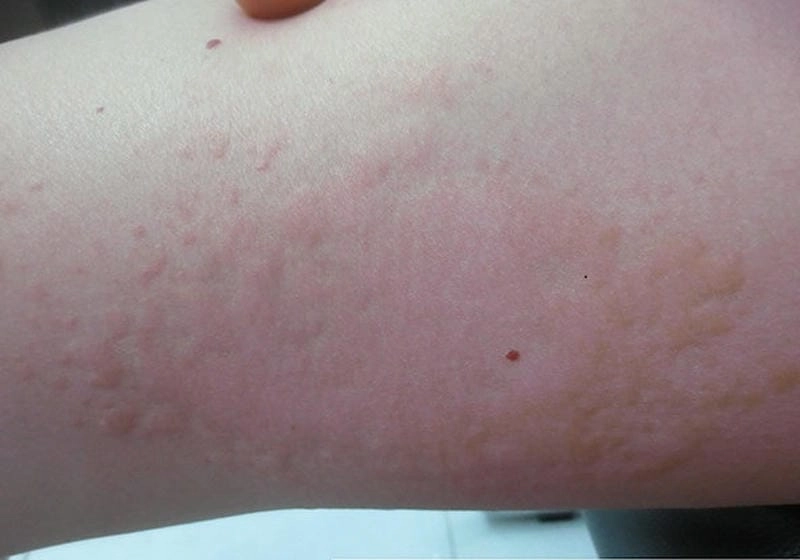 Hình ảnh bệnh sán chó ở người phản ánh rõ dấu hiệu viêm da