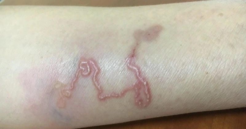 Bệnh sán chó ở người có thể dẫn đến biến chứng về da liễu