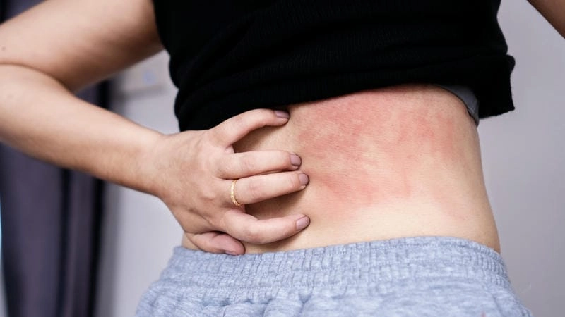 Hình ảnh bệnh sán chó ở người giúp chẩn đoán nhanh triệu chứng