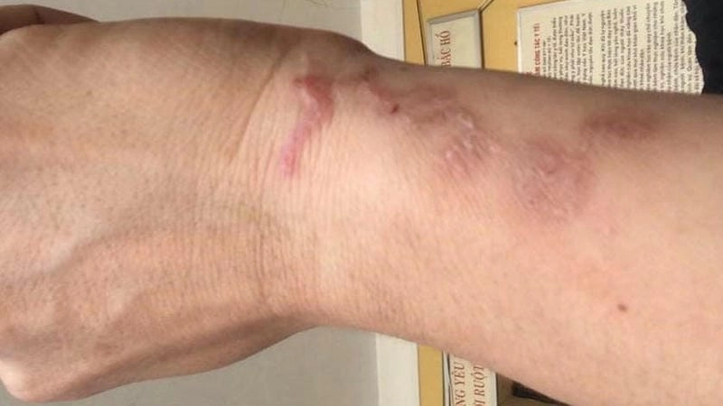 Triệu chứng sán chó ở người thường gặp là nổi mẩn đỏ toàn thân