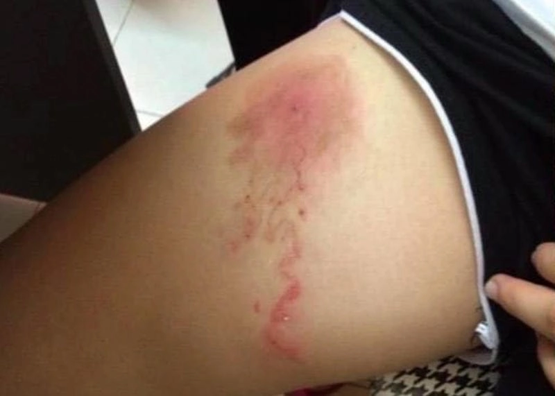 Hình ảnh bệnh sán chó giúp phát hiện sớm dấu hiệu bất thường