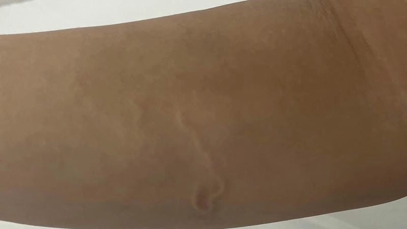 Hình ảnh sán chó ở người xuất hiện rõ trên cổ và lưng