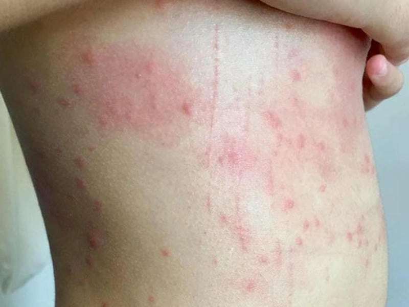 Hình ảnh sán chó trên da gây nổi mẩn đỏ và sưng viêm kéo dài