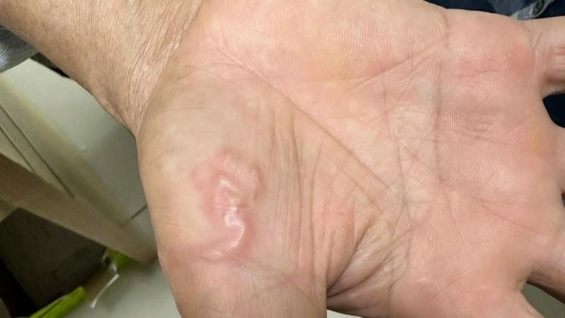 Hình ảnh sán chó ở người cảnh báo tình trạng dị ứng kéo dài