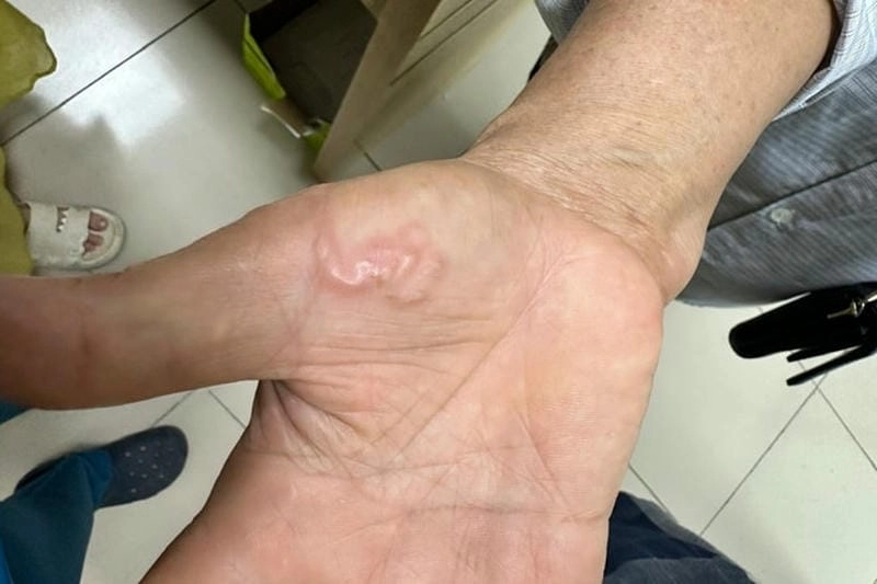 Bệnh sán chó ở người lớn dễ bị chẩn đoán nhầm với dị ứng