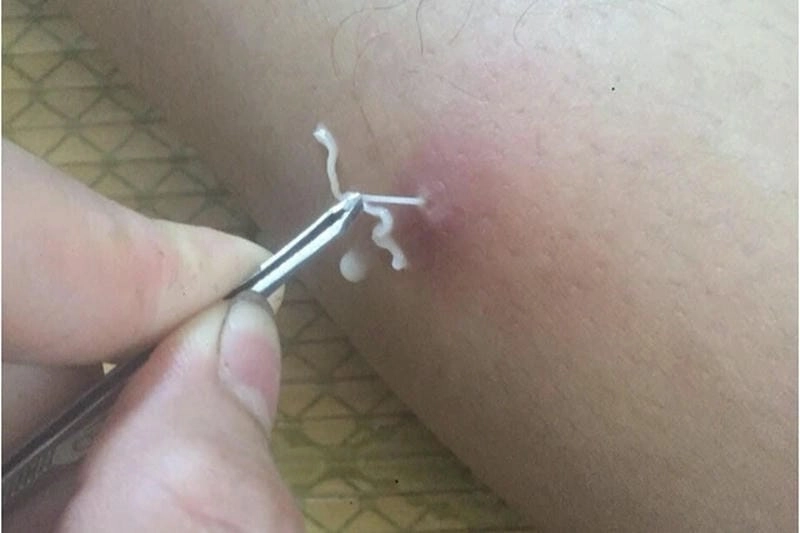 Hình ảnh giun sán chó phóng đại giúp nhận diện ký sinh trùng