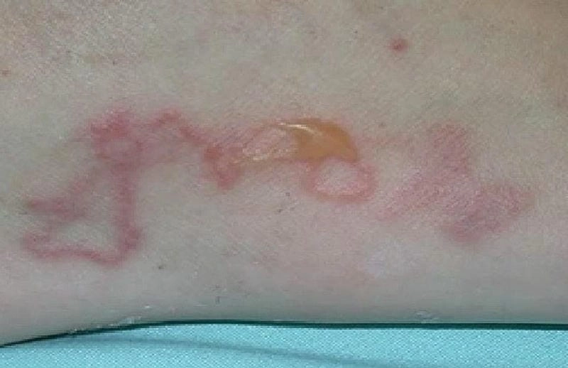 Ảnh sán chó mô phỏng thực tế từ ca bệnh đã được ghi nhận