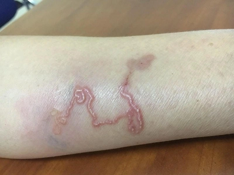 Hình ảnh người bị sán chó có vết mẩn đỏ kéo dài ở tay chân