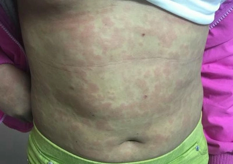 Ảnh sán chó chân thực giúp bạn nhận diện sớm bệnh