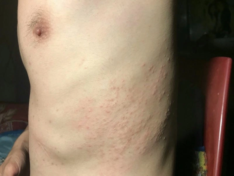 Hình ảnh sán chó ở người phổ biến ở vùng da tay và chân