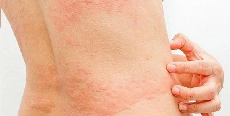 Hình dạng sán chó dài dẹp đầu nhọn giống giun móc