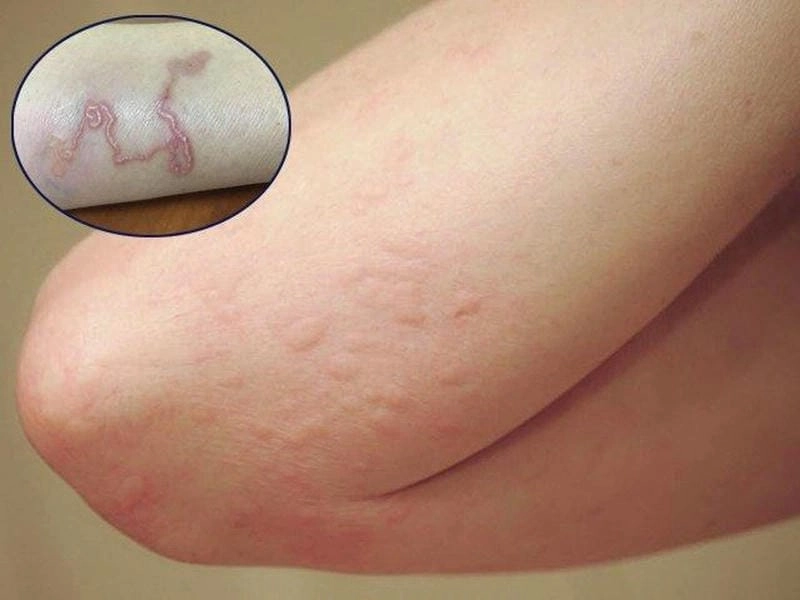 Hình ảnh giun sán chó trong mô tả sinh học rõ từng chi tiết