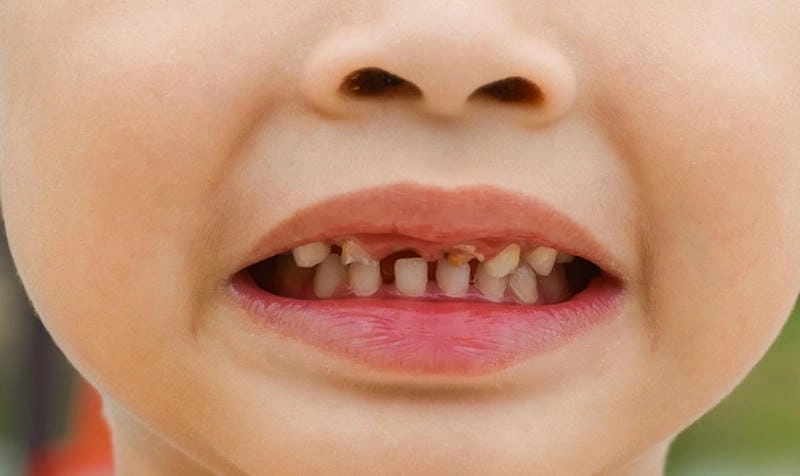 Thực trạng phổ biến qua hình ảnh em bé sún răng
