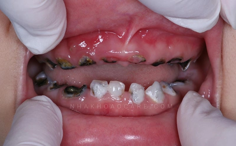 Phổ biến nhất là bệnh sâu răng ở trẻ em