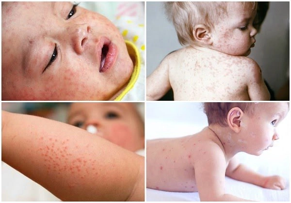 Dấu hiệu nhận biết hình ảnh trẻ nổi ban do sởi kèm sốt